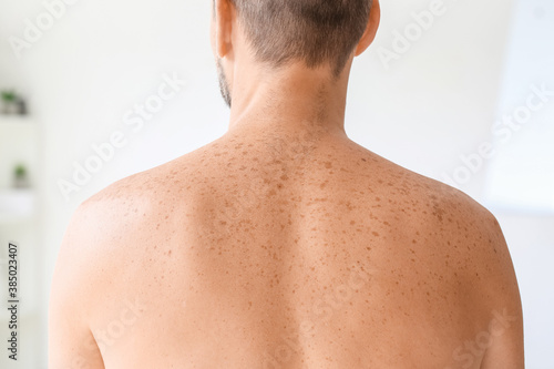 Fotografía Man with freckles at dermatologist's office