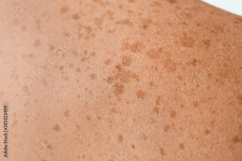 фотографія Human skin with freckles, closeup