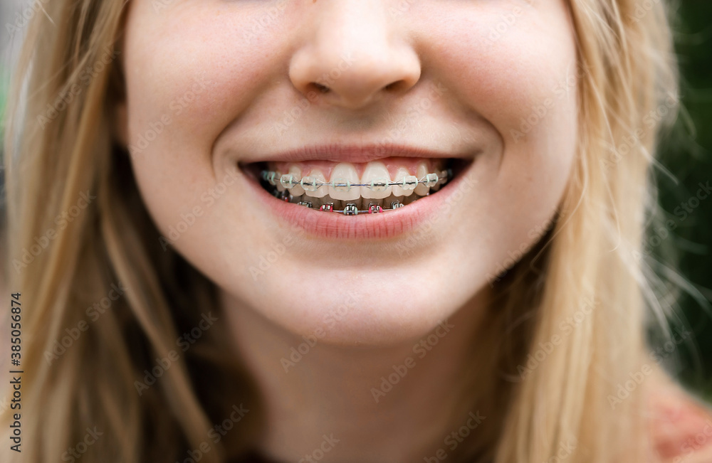 The smiling mouth of a young blonde girl with fixed braces. The smiling mouth of a young blonde girl with fixed braces.