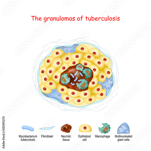 The granulomas of tuberculosis. structure of granuloma