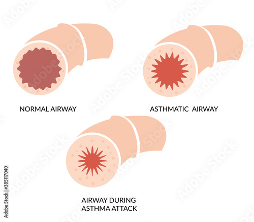 Asthma Blocked Airway - Icon