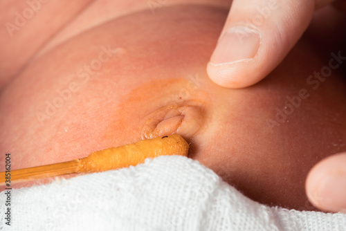 Disinfect the navel of a newborn photo