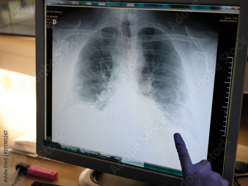 Chest x-ray image photo