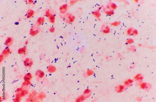 Fotografi Bacteria Gram positive in sputum gram stain.