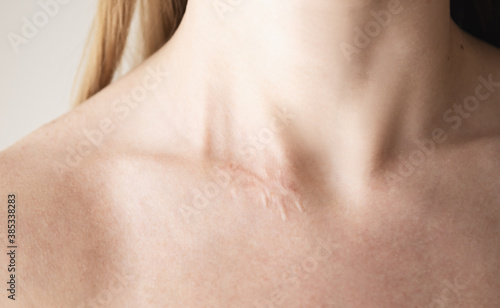 Woman with surgery scar at her neck.