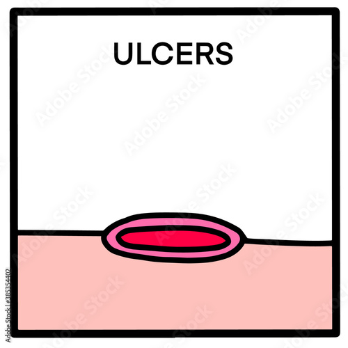 Ulcers hand drawn vector illustration in cartoon doodle style