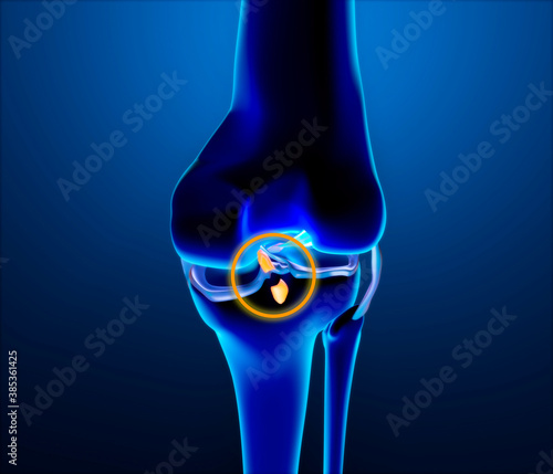 Broken posterior cruciate ligament. Injury and rupture. Enlargement of the bones of the knee, femur and tibia. 3d render photo