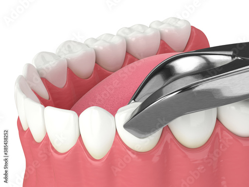 3d render of lower jaw with tooth extraction photo