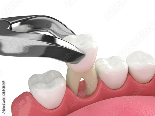 3d render of lower jaw with tooth extraction photo