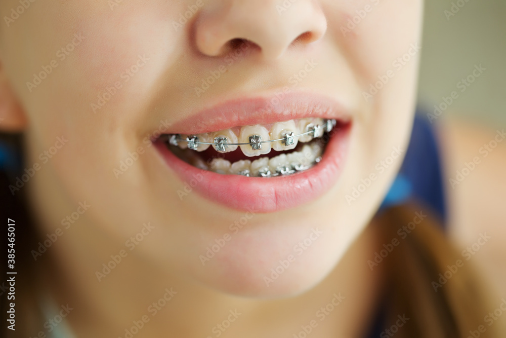 Close up portrait of smiling teenager girl showing dental braces.Isolated on white background. High quality photo. Close up portrait of smiling teenager girl showing dental braces.Isolated on white background. High quality photo.