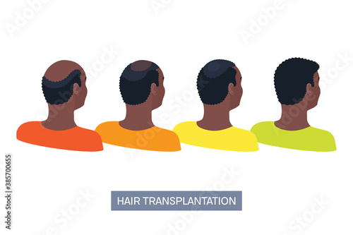 Afro-textured hair transplantation surgery result infographics. African male patient before and after hair loss treatment with FUT, FUE methods. Treating alopecia medical poster. Vector illustration.
