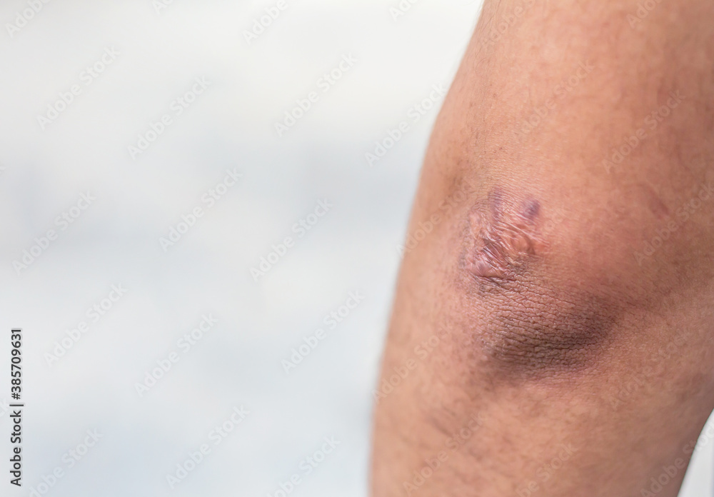 Fototapeta premium Man with scar on his arm