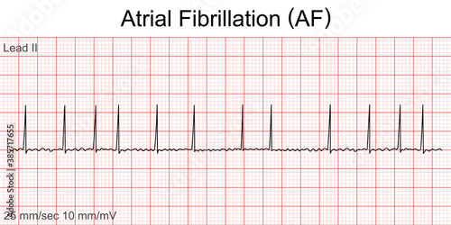 Electrocardiogram show Atrial fibrillation (AF) pattern. Cardiac fibrillation. Heart beat. CPR. ECG. EKG. Vital sign. Life support. Defib. Emergency. Medical healthcare symbol.