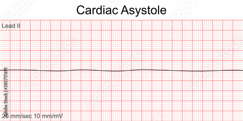 Electrocardiogram show Cardiac asystole pattern. Cardiac fibrillation. Heart beat. CPR. ECG. EKG. Vital sign. Life support. Defib. Emergency. Medical healthcare symbol.