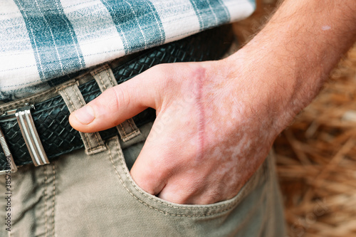 Healed scar on the arm of a man with vitiligo
