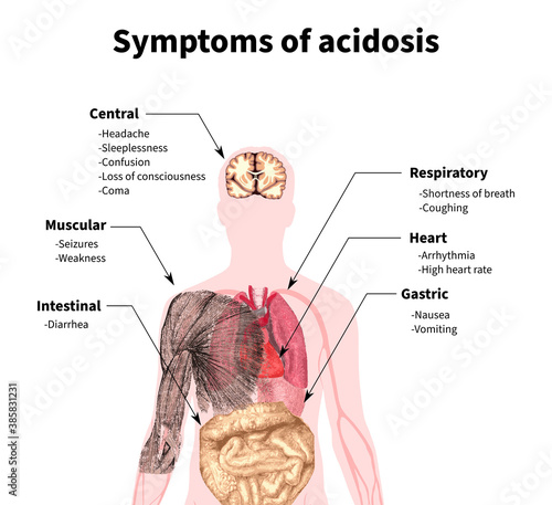 Acidosis, symptoms, acidity, blood, body, tissues, plasma, respiratory, metabolic