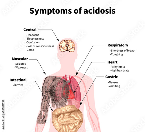 Acidosis, symptoms, acidity, blood, body, tissues, plasma, respiratory, metabolic photo