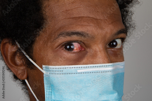 Portrait of African man showing a red eye, concept of one of the symptoms of covid 19