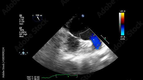 Image of the heart during transesophageal ultrasound with Doppler mode.