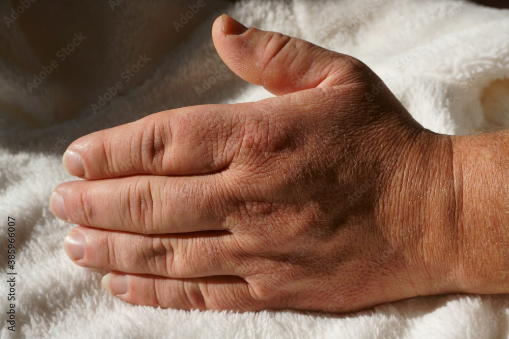 Fototapeta premium akromegalia