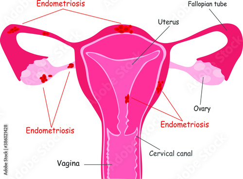 Concept endometriosis. The women's reproductive system, gynecological diseases isolated on white background. A realistic drawing showing the internal organs. Frontal view in a cut.