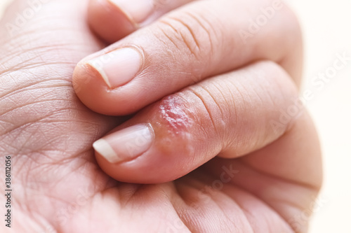 Red rash allergy Inflammation on little finger
