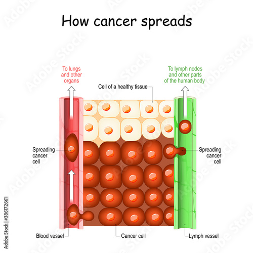 How cancer spreads.