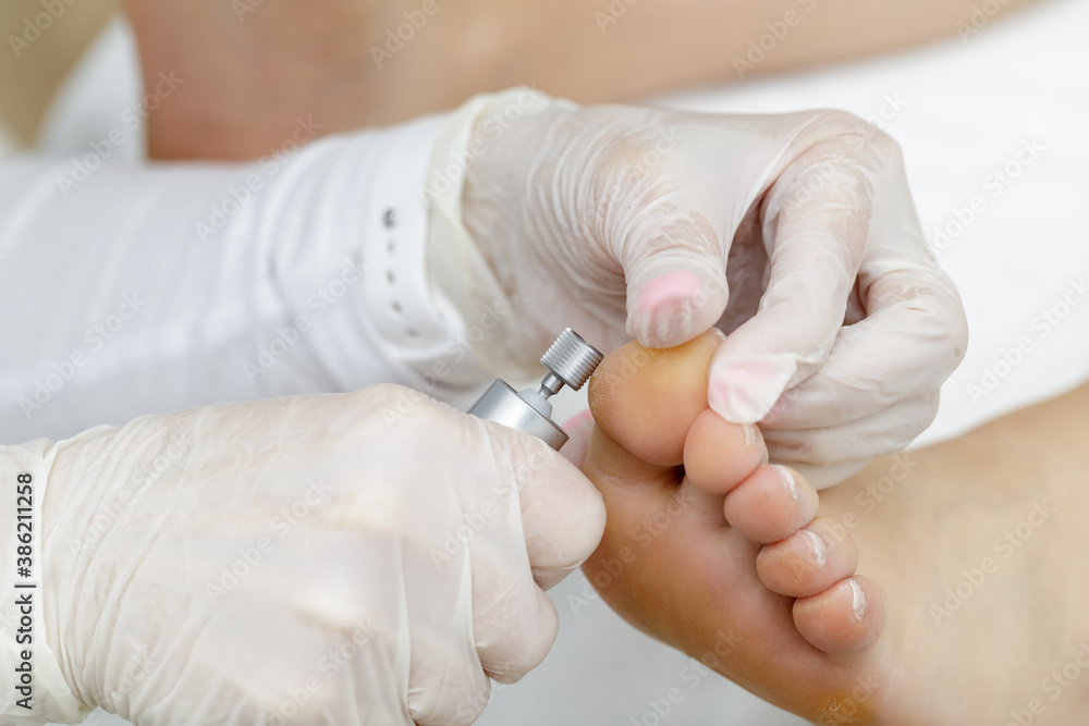 The podiatrist using the professional device to treat the patient's calluses The podiatrist using the professional device to treat the patient's calluses