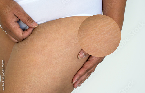 Image compare before and after Woman buttocks with stretch marks removal treatment, real people photo