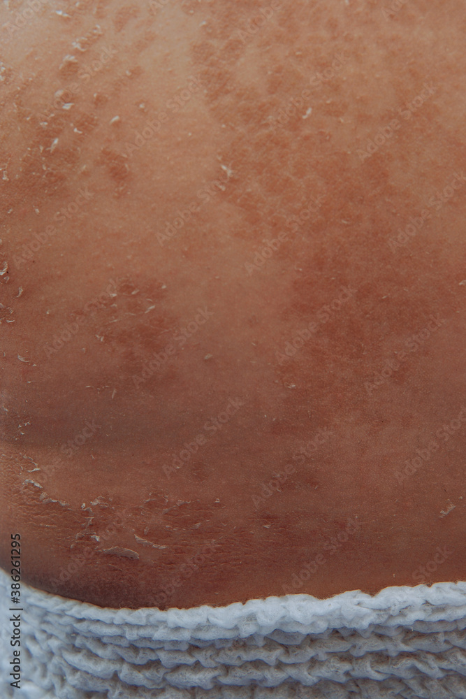 Fototapeta premium baby skin peeling after previously inflamed red