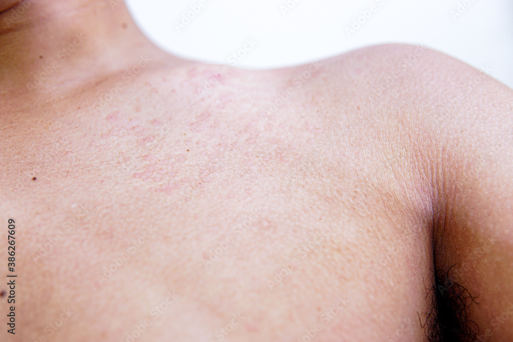 red inflamed skin on a man's body. skin fungus causing white blotches. Atopic eczema red inflamed skin on a man's body. skin fungus causing white blotches. Atopic eczema