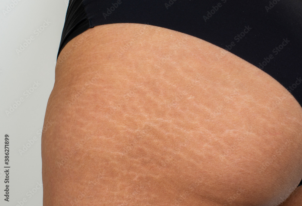 Close up stretch marks on Asian woman skin. Imperfect skin isolate on white  background. Stock-Foto | Adobe Stock
