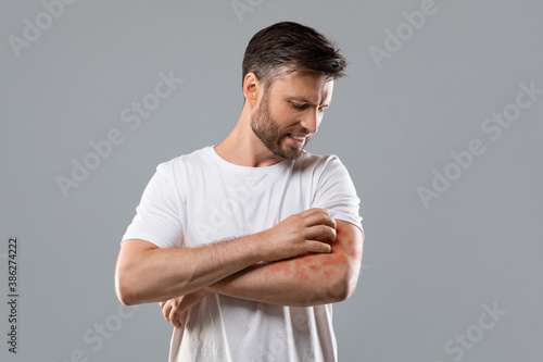 Obraz na płótnie Annoyed man scratching itch on his arm