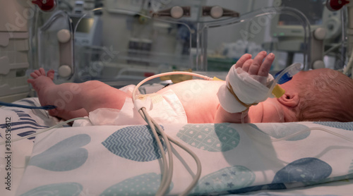 Photo of a newborn premature sick baby in incubator with monitoring sensors and catheters. Neonatal intensive care unit