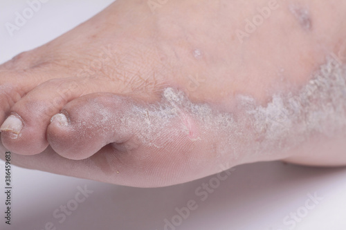 Closeup of the legs of a woman suffering from chronic psoriasis on a white background. Closeup of rash and scaling on the patient s skin. Dermatological problems. Dry skin. Isolated