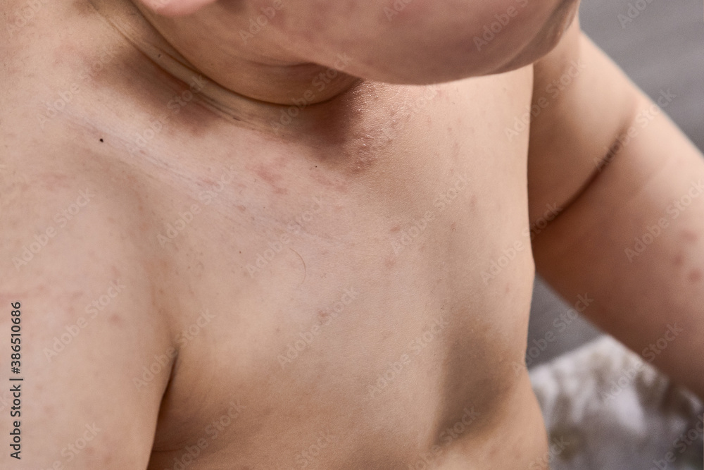roseola rash a viral rash on the skin of a child roseola rash a viral rash on the skin of a child