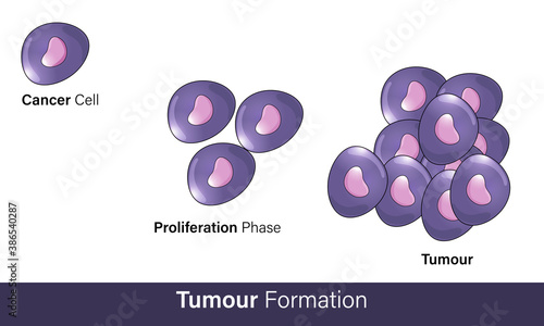 cancer cell formation due to mutagenic even vector concept inphograph. mutagenesis or tumorigenesis,  mechanism, steps of cancer formation. science and education purpose.