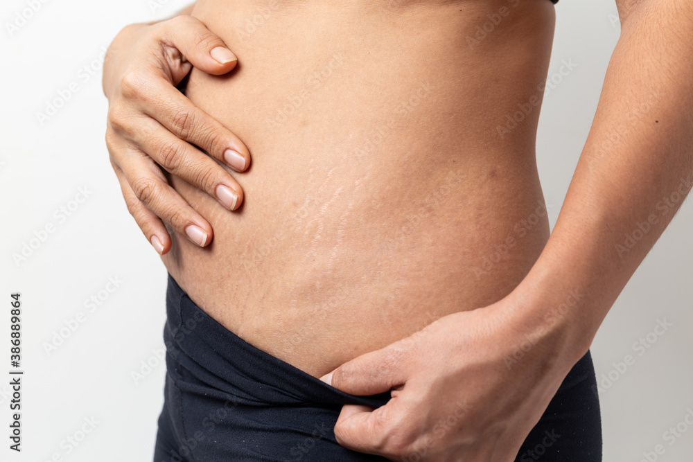 Stretch Marks, Women Show off the belly after birth on white background Stretch Marks, Women Show off the belly after birth on white background