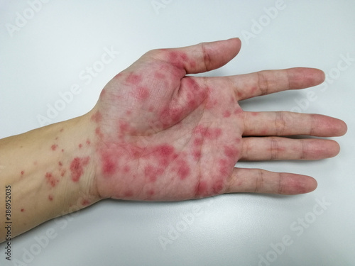 Fotografie Close up hand with red marks on skin as allergy from dermatitis