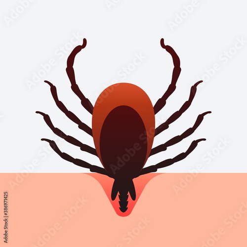 Encephalitis mite bites through human skin