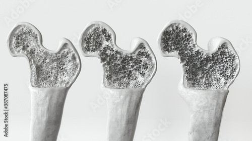 Osteoporosis 3 Stages - 3D Rendering