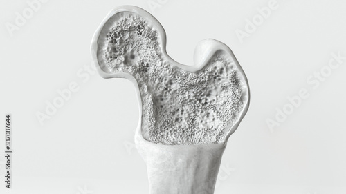 Osteoporosis stage 1 of 3 -- 3d rendering