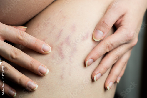 big, wide stretch marks on tigh after pregnancy. Fresh stretch marks possible to erase with laser therapy. Aesthetic medicine, cosmetology concept.