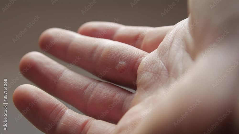 Dermatology warts hand fingers man skin closeup refocusing Dermatology warts hand fingers man skin closeup refocusing