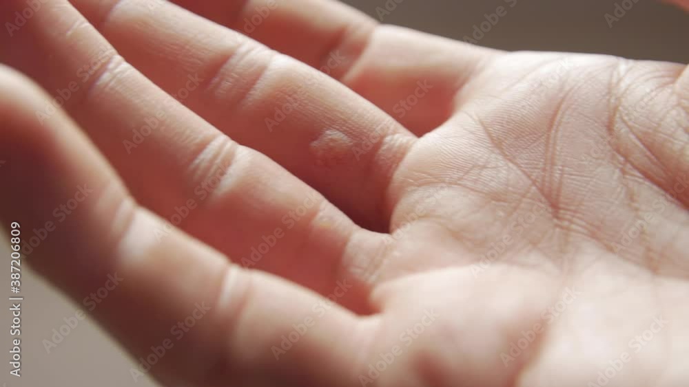 Hand with wart man skin closeup Hand with wart man skin closeup