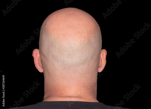Quadro em tela Rear view of a bald head