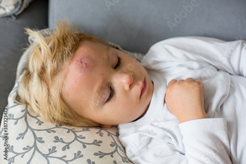 Toddler boy, lying on the couch with big bump on the forehead after falling from a swing