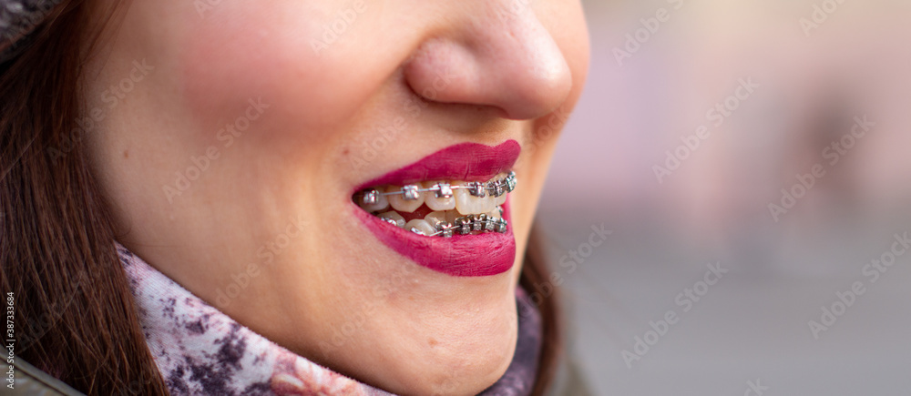 The brace system in the girl's smiling mouth, macro photography of teeth, close-up of red lips. Girl walking on the street The brace system in the girl's smiling mouth, macro photography of teeth, close-up of red lips. Girl walking on the street