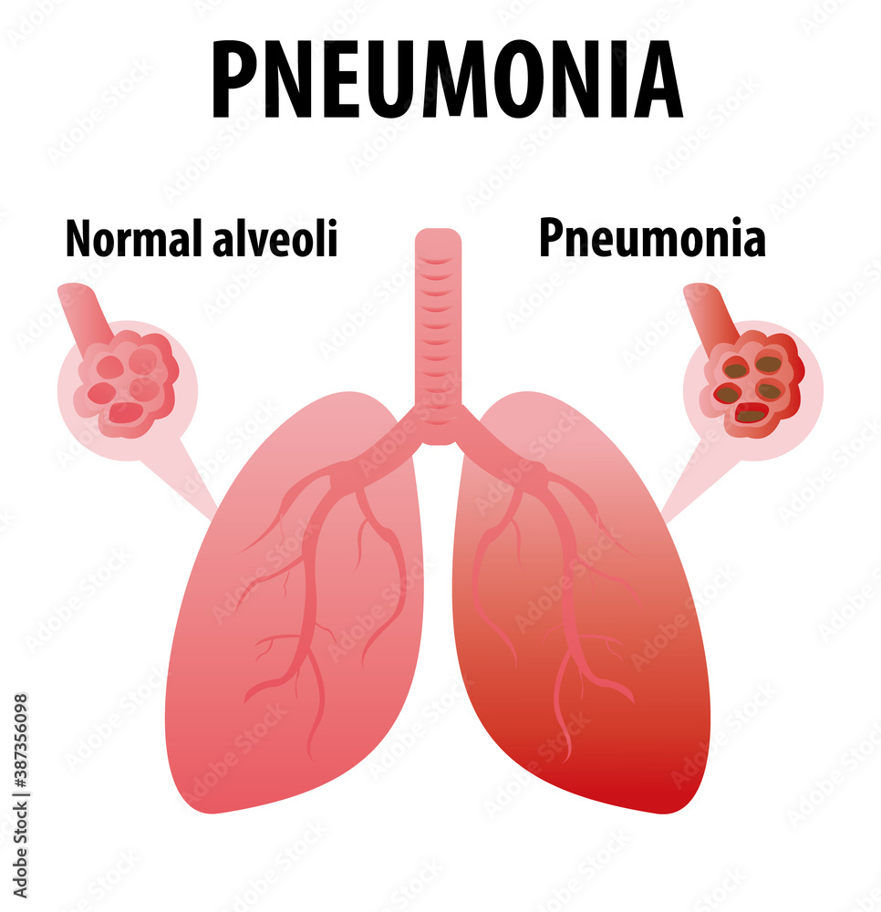 Pneumonia. Normal and infected alveoli. Healthy and ilness lungs cartoon flat icon for web design isolated on white background. Scientific medical concept illustrations.Respiratory system Pneumonia. Normal and infected alveoli. Healthy and ilness lungs cartoon flat icon for web design isolated on white background. Scientific medical concept illustrations.Respiratory system