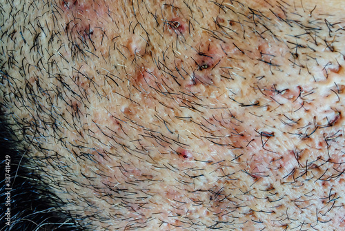 Tableau sur toile Close up of caucasian skin with many ingrown hairs
